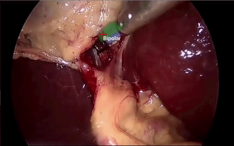 Medical AI — Surgical Tools Detection